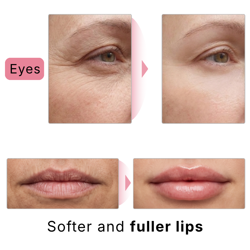 Before and after: softer, fuller lips and smoother eyes